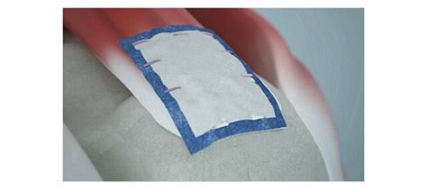 patch saddle nephew|Study shows Smith+Nephew's REGENETEN™ .